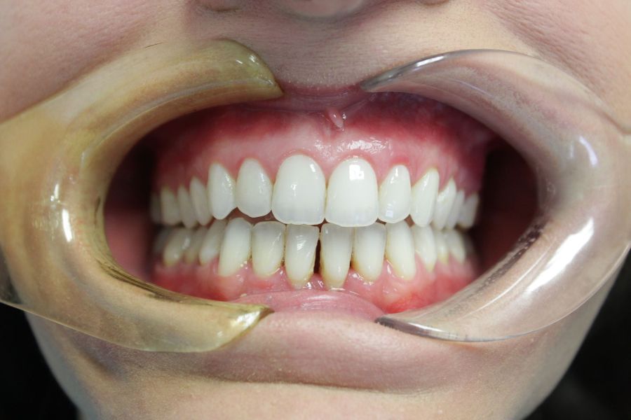 A close up of a person 's teeth with a mouth guard.