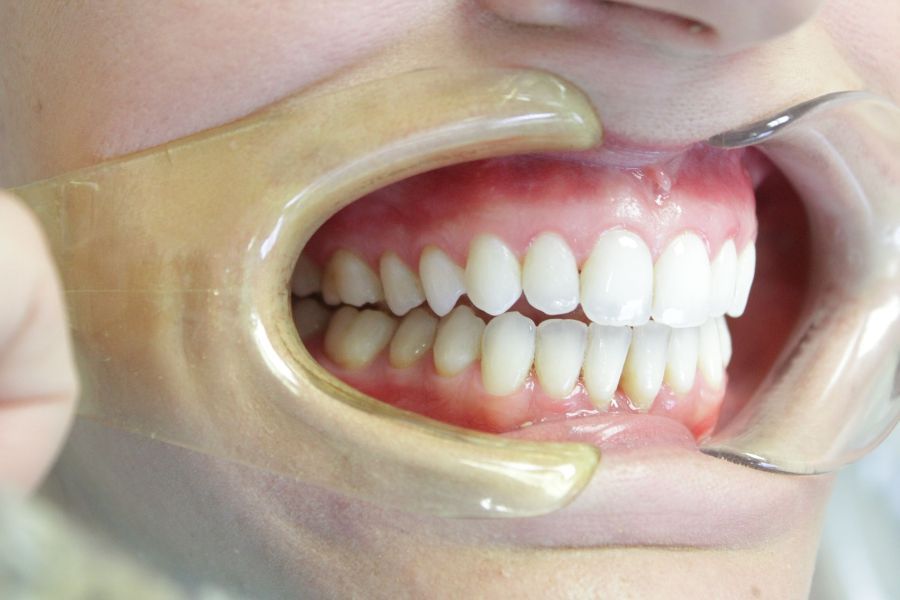 A close up of a person 's teeth with a mouth guard.