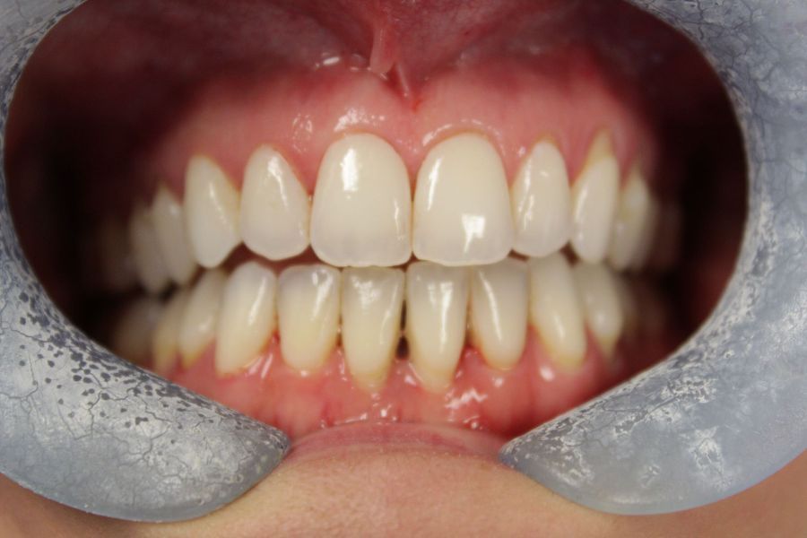 A close up of a person 's teeth with a mouth guard.