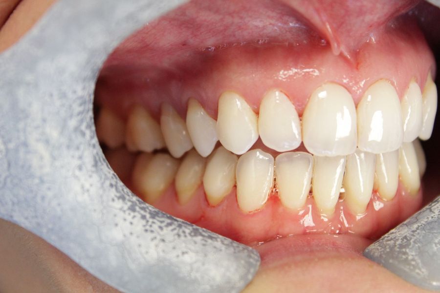 A close up of a person 's teeth with a mouth guard.
