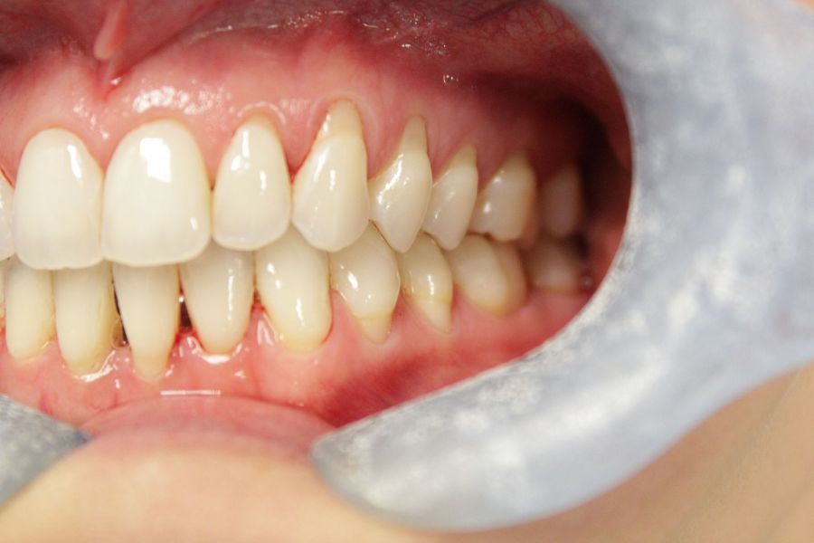 A close up of a person 's teeth with a mouth guard.