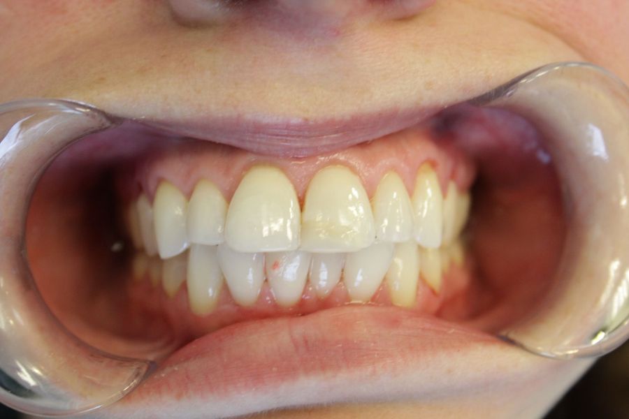 A close up of a person 's mouth with white teeth.