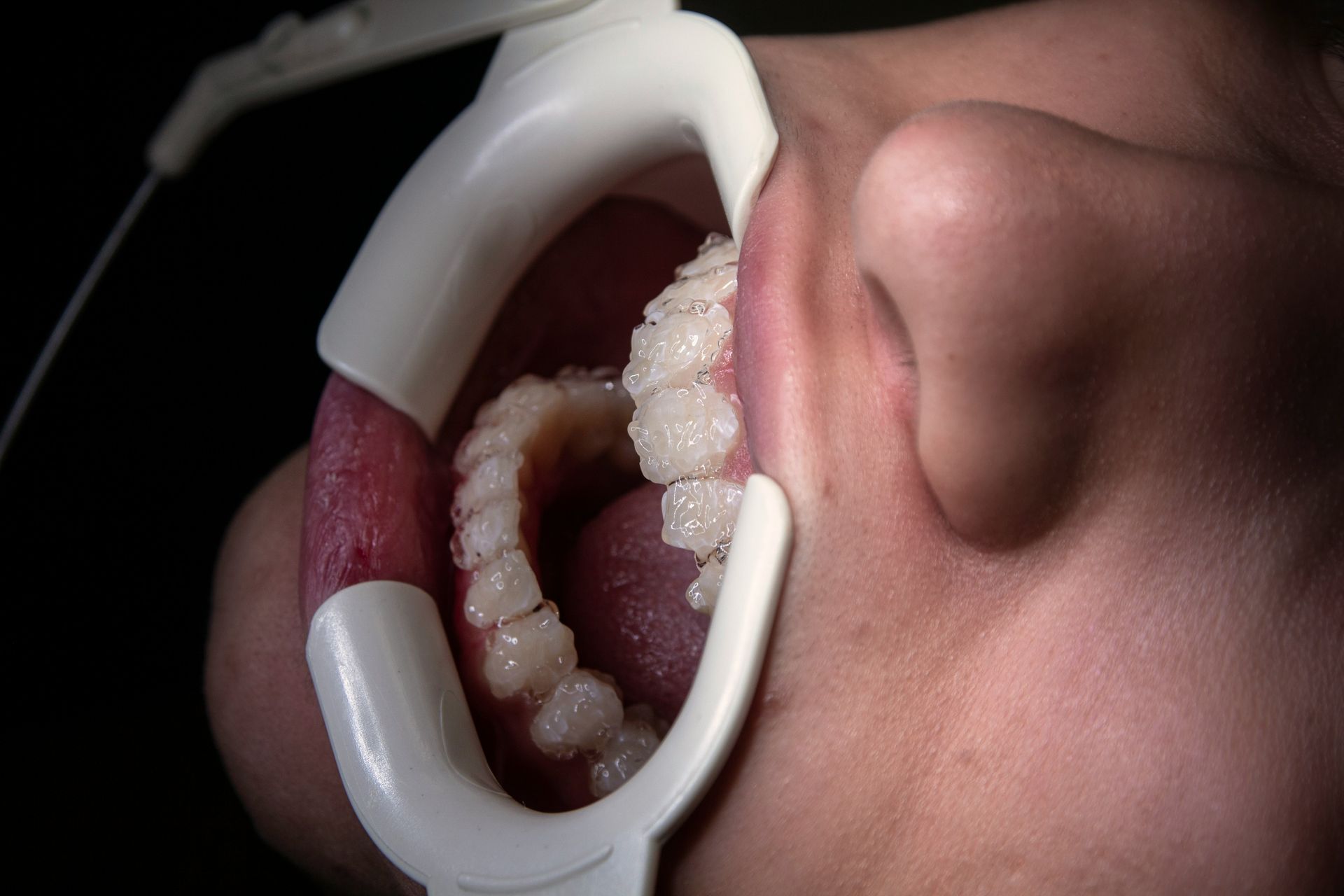 Mouth open with teeth visible, held open by a white dental retractor. Tongue and inner cheek are red.