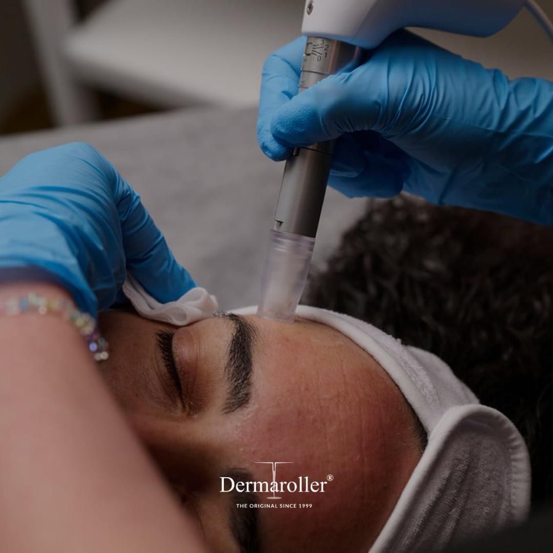 Person receiving a microneedling treatment on forehead. Gloved hands holding the device.
