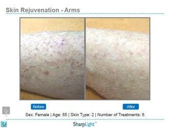 Comparison of arm skin before and after skin rejuvenation treatments.
