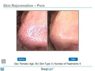 Comparison of a nose before and after skin rejuvenation treatment, showing reduced pore size.