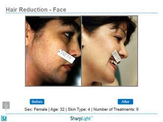 Before and after facial hair reduction. A woman, age 32, with dark skin, post-9 treatments.