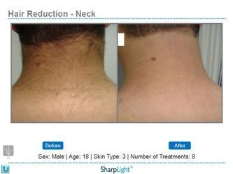 Comparison of a neck with hair before (left) and after (right) hair reduction treatment.