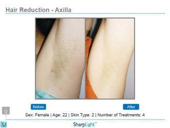 Hair reduction comparison: axilla (armpit) before/after 4 treatments.