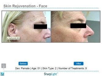 Skin rejuvenation comparison: Before and after photos of a face, showing reduced wrinkles. Includes text indicating the person is female, 51 years old, and has had 9 treatments.