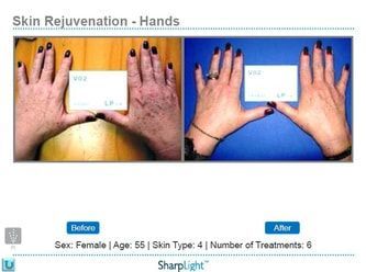 Before and after hand photos showing skin rejuvenation. Includes patient age/sex, skin type and number of treatments.