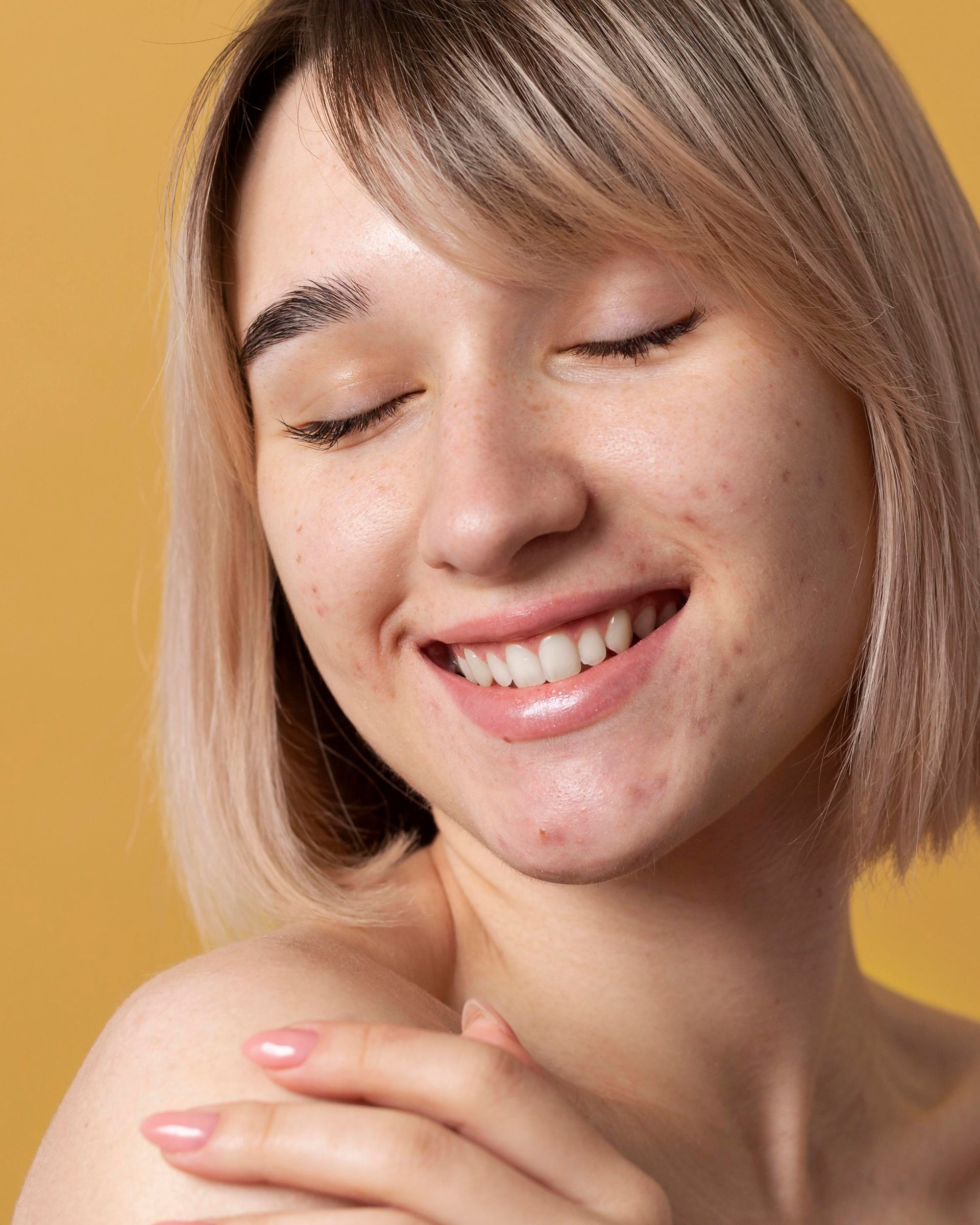 close up smiley woman posing with acne