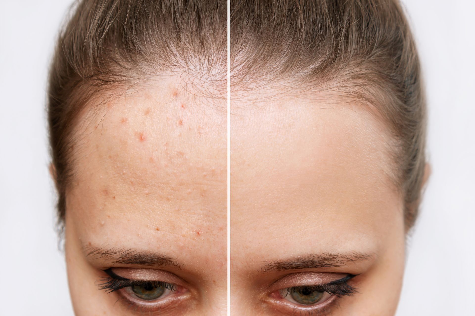cropped shot young woman face before after acne