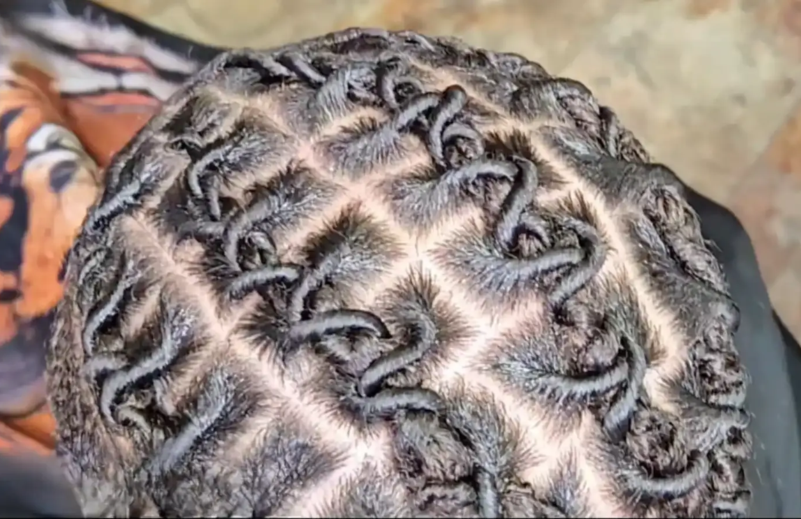 Overhead view of a person's scalp with a grid of square parts, with patterned hair.