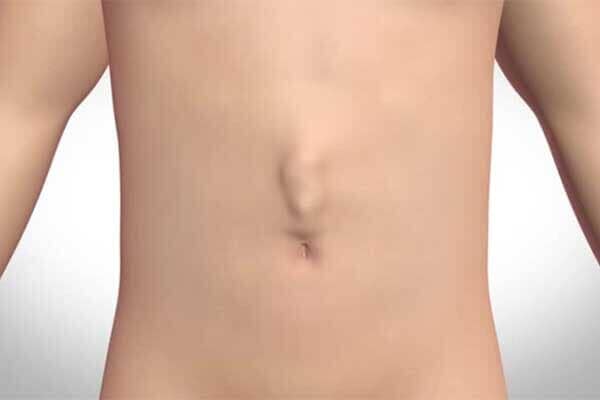 HERNIAQX - Hernia Hiatal