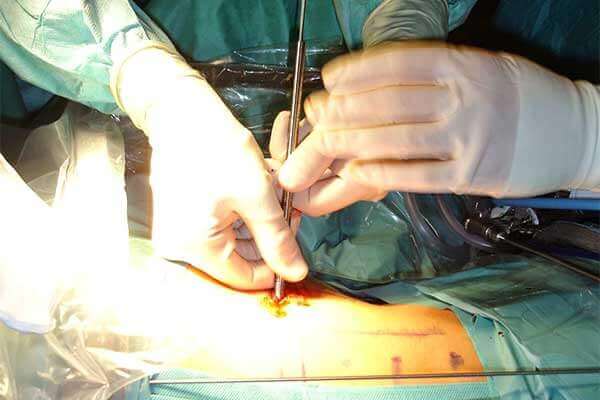 HERNIAQX - Hernia Umbilical