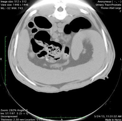 A ct scan of the abdomen of a person