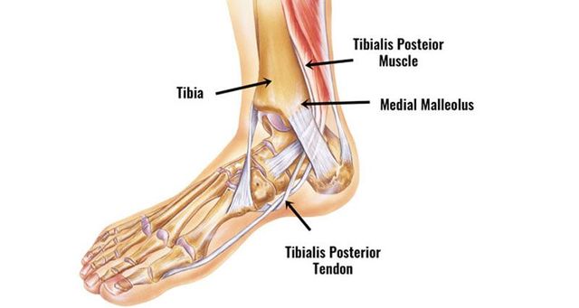 Using Shockwave, Foot Core Exercises to Manage Tibialis Posterior