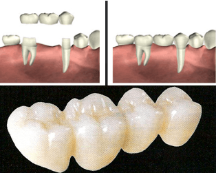 Tooth Colored Fillings - Christiana Pleasant Dental