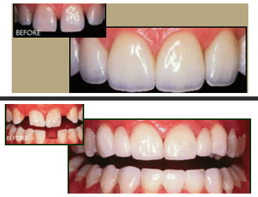 Tooth Colored Fillings - Christiana Pleasant Dental
