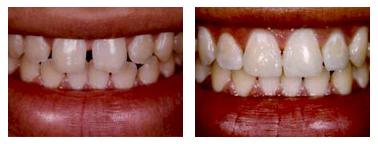 Tooth Colored Fillings