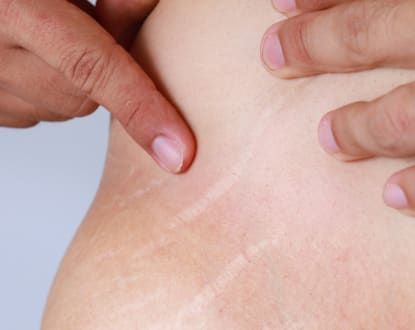 A photo of Stretch Mark