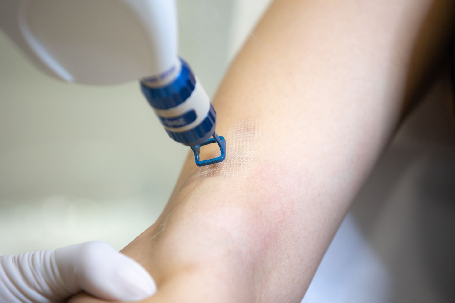 A person is getting a laser treatment on their arm.