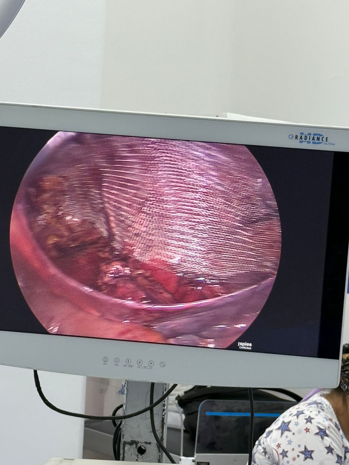 Equipo para cirugía laparoscópica