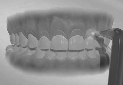 A black and white photo of a person 's teeth being examined by a dentist.