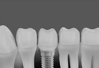 A row of teeth with a dental implant in the middle.