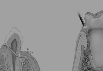 A black and white drawing of a tooth with a needle in it.