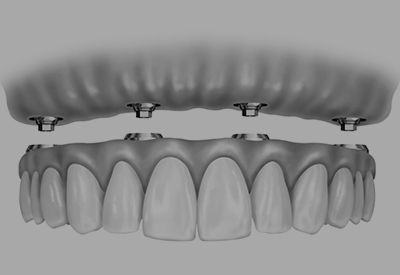 A black and white drawing of a full denture.
