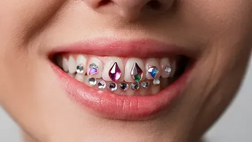 A close-up of a smiling mouth featuring decorative, multi-colored gemstone tooth jewelry on the upper and lower teeth.