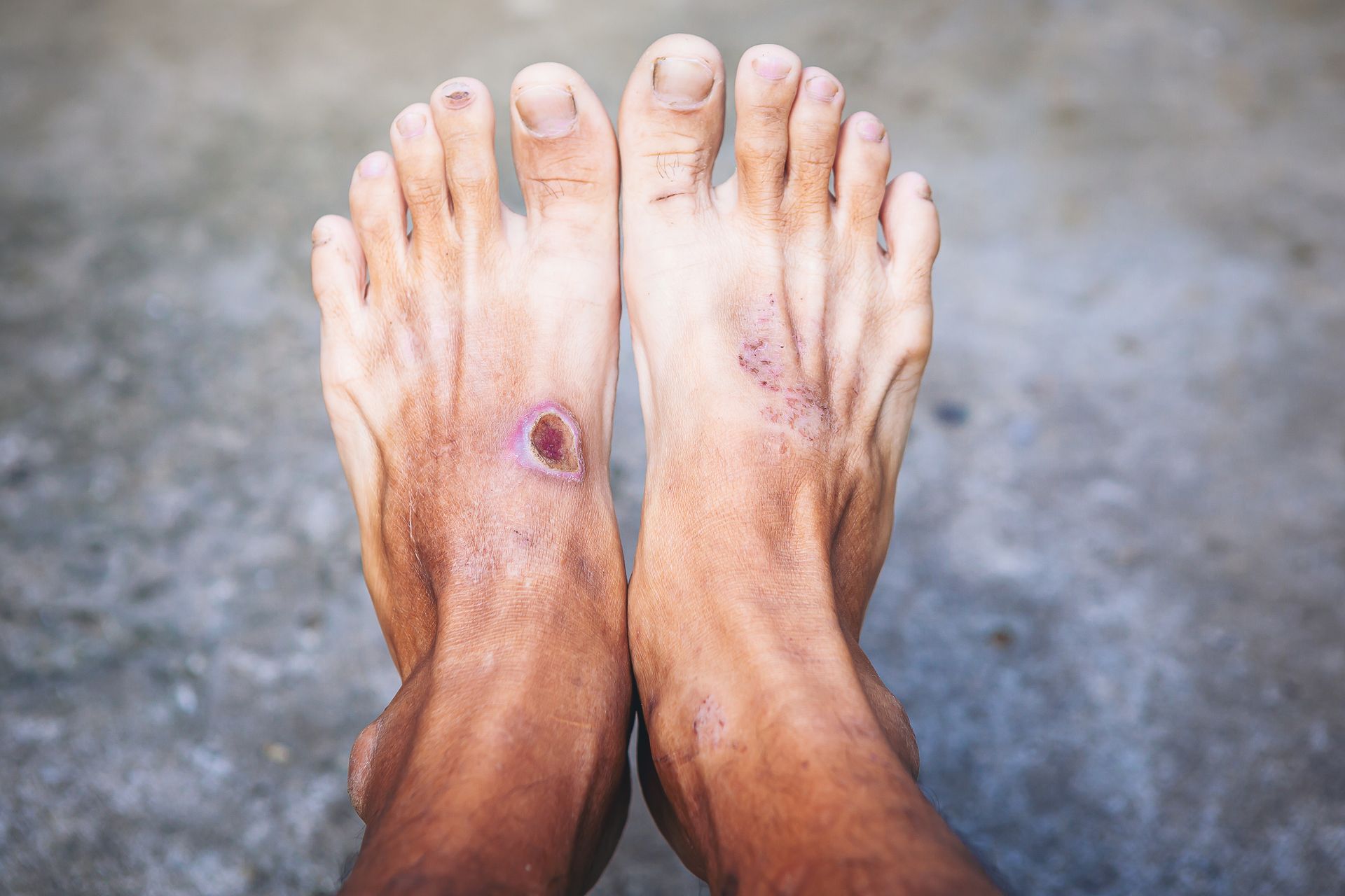 Pair of feet with visible skin damage and sores on the tops.