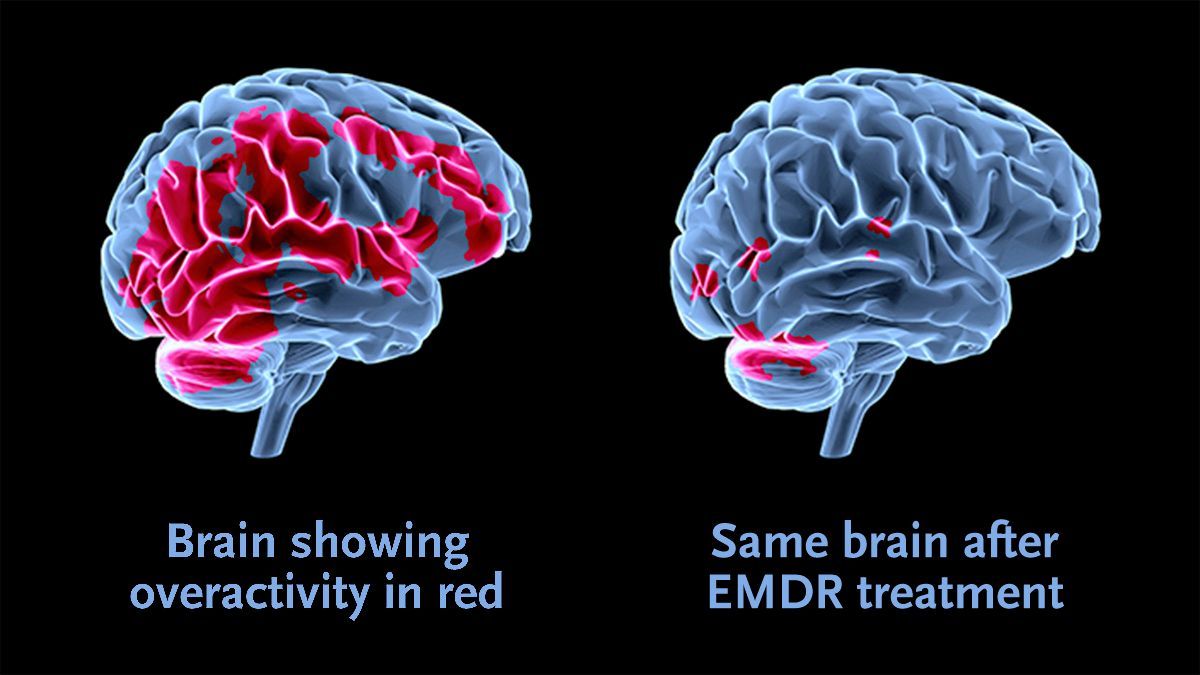 The brain in trauma vs the brain after EMDR Therapy
