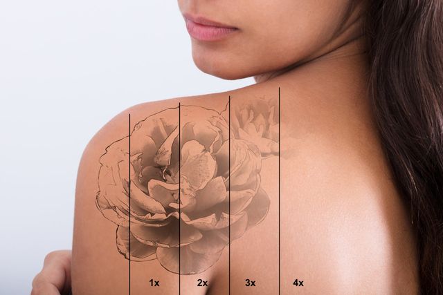 How Long Does Laser Tattoo Removal Take  Impressions Skin