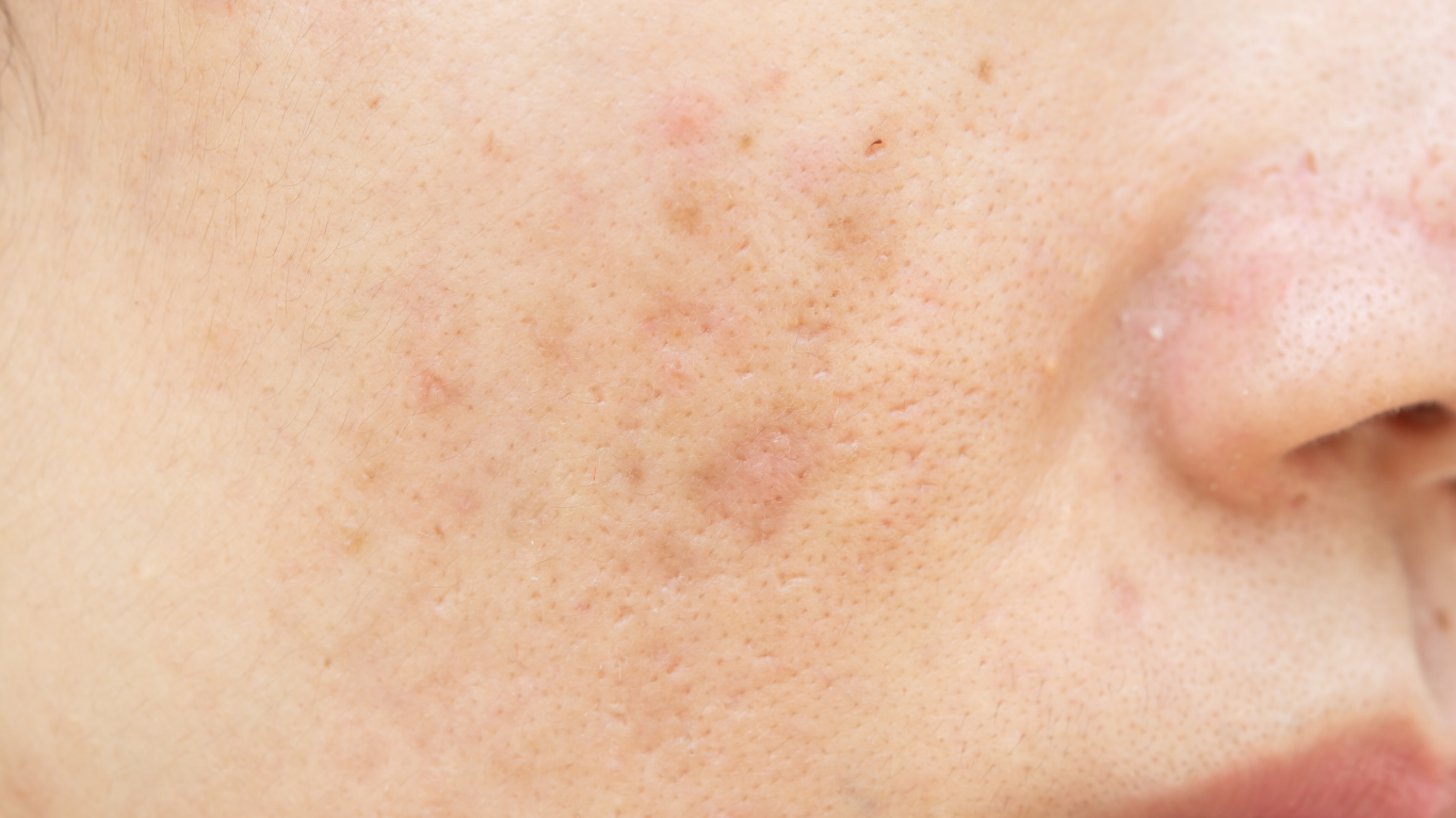 Close-up of a person's face showing uneven skin texture with acne scars and blemishes near the nose.