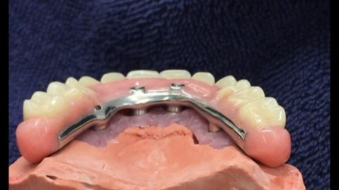 view of a denture with metal plate