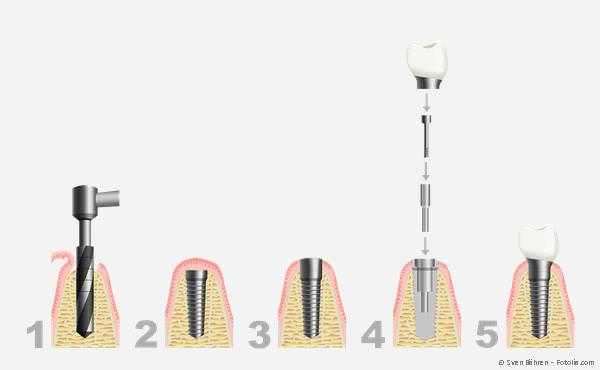Die meisten Implantate werden im sog. zweiphasigen Verfahren eingesetzt.
