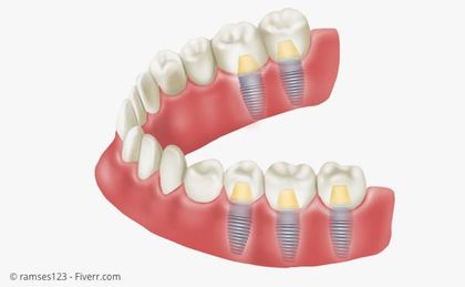 Implantate mit Kronen statt herausnehmbarem Zahnersatz