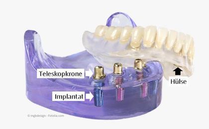 Mit nur wenigen Implantaten pro Kiefer können Zahnprothesen wieder einen festen Halt bekommen.