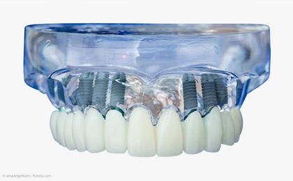 Mit mehreren Implantaten pro Kiefer können festsitzende Zähne anstelle von Totalprothesen gemacht werden.