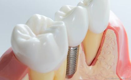 Mit der sogenannten Socket Preservation wird dem Abbau der Kiefer nach Zahnverlust vorgebeugt.