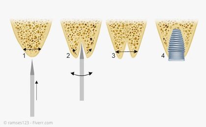 Bone Spreading: Ein zu schmaler Kieferkamm wird im Bereich des Implantats verbreitert