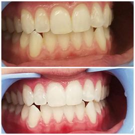 Teeth Whitening Sanford, Pinehurst & Fayetteville, NC