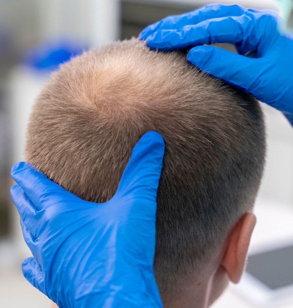 A person wearing blue gloves is examining a man 's hair.
