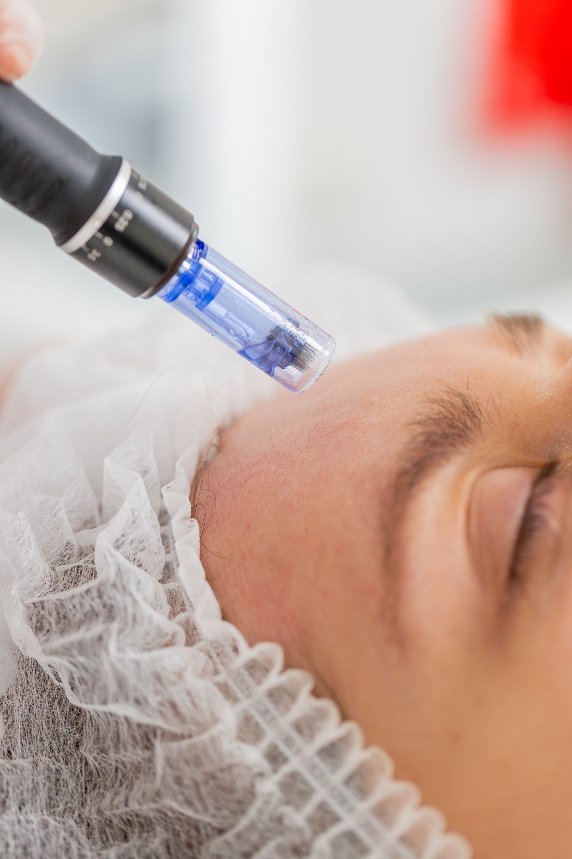A woman is getting a microneedle treatment on her face.