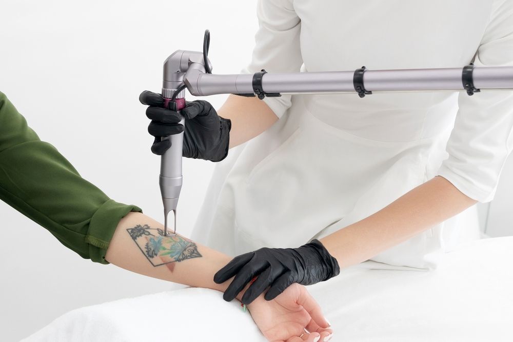 A person is getting a tattoo removed from their arm.