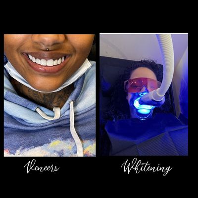 Mobile Tooth Gems – Philadelphia, PA - Halo Ali Teeth Whitening