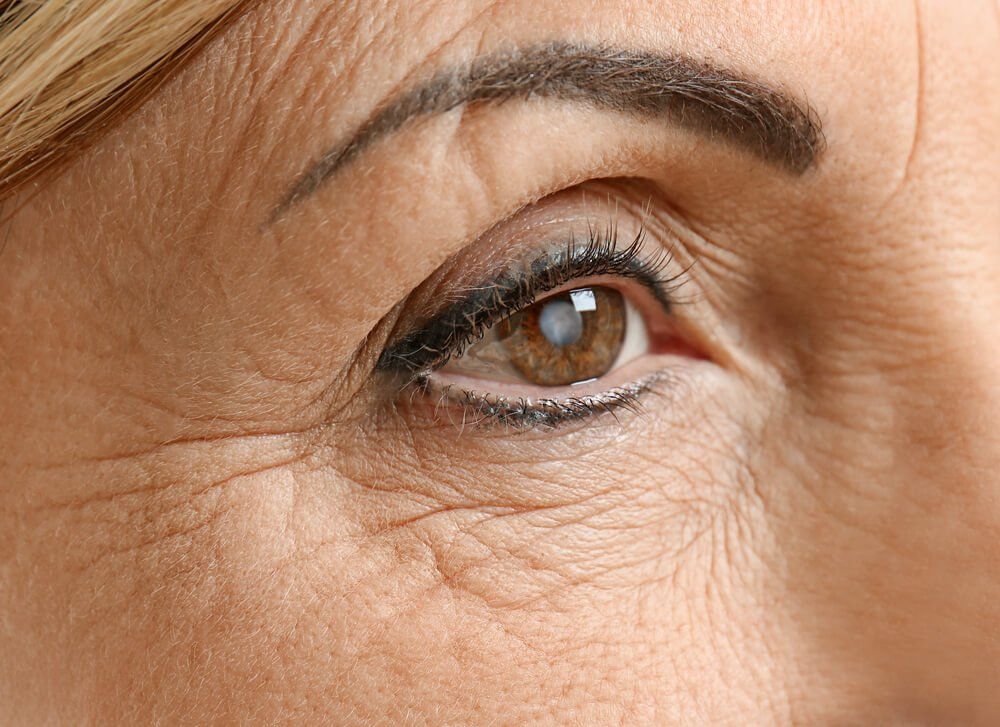 Woman With Cataracts — Your Ophthalmologist in Townsville, QLD